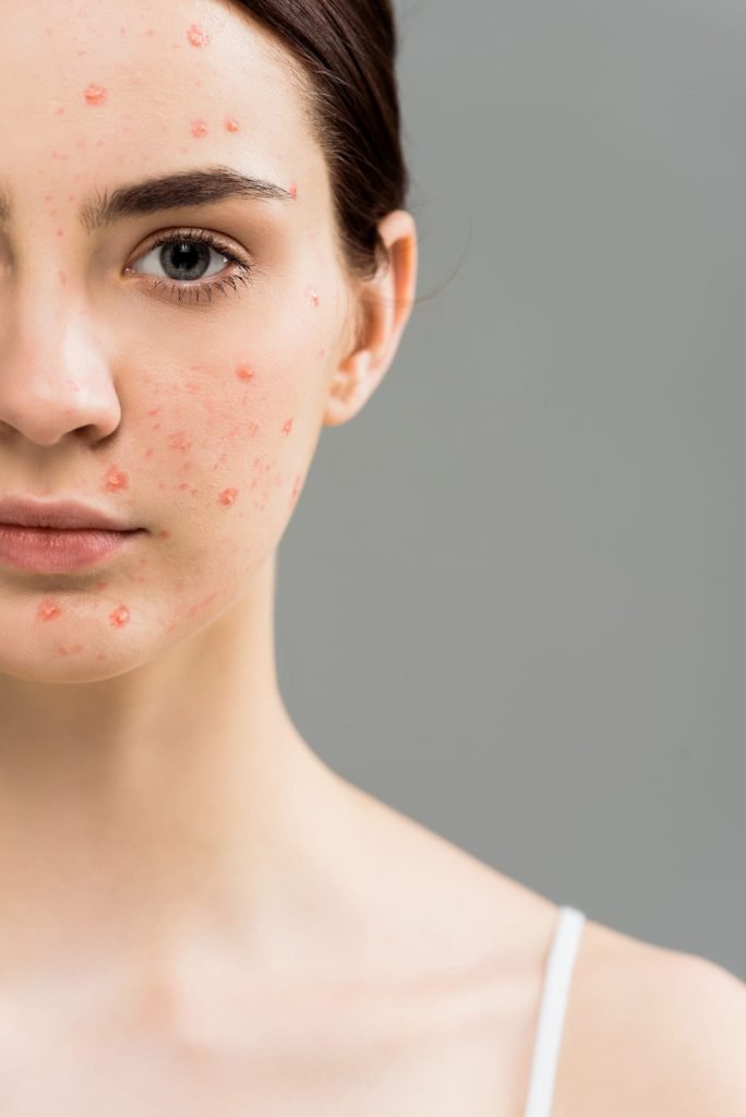 Young woman with acne